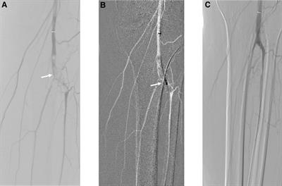 Percutaneous mechanical thrombectomy using the Rotarex®S device for the treatment of acute lower limb artery embolism: A retrospective single-center, single-arm study
